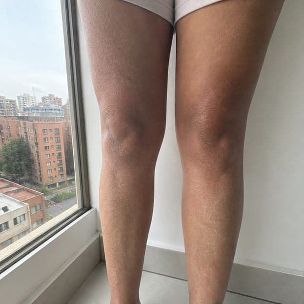 Valeria P. - resultado en 21 dias - antes
